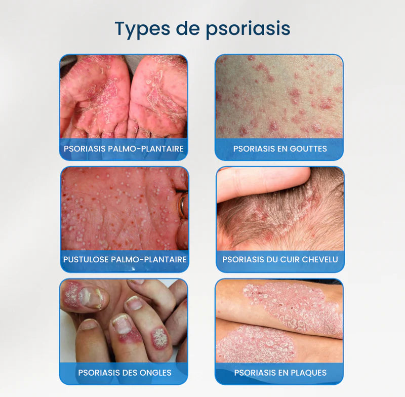 Myesaa™ Crème apaisante pour peaux sujettes au psoriasis