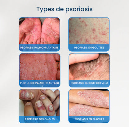 Myesaa™ Crème apaisante pour peaux sujettes au psoriasis